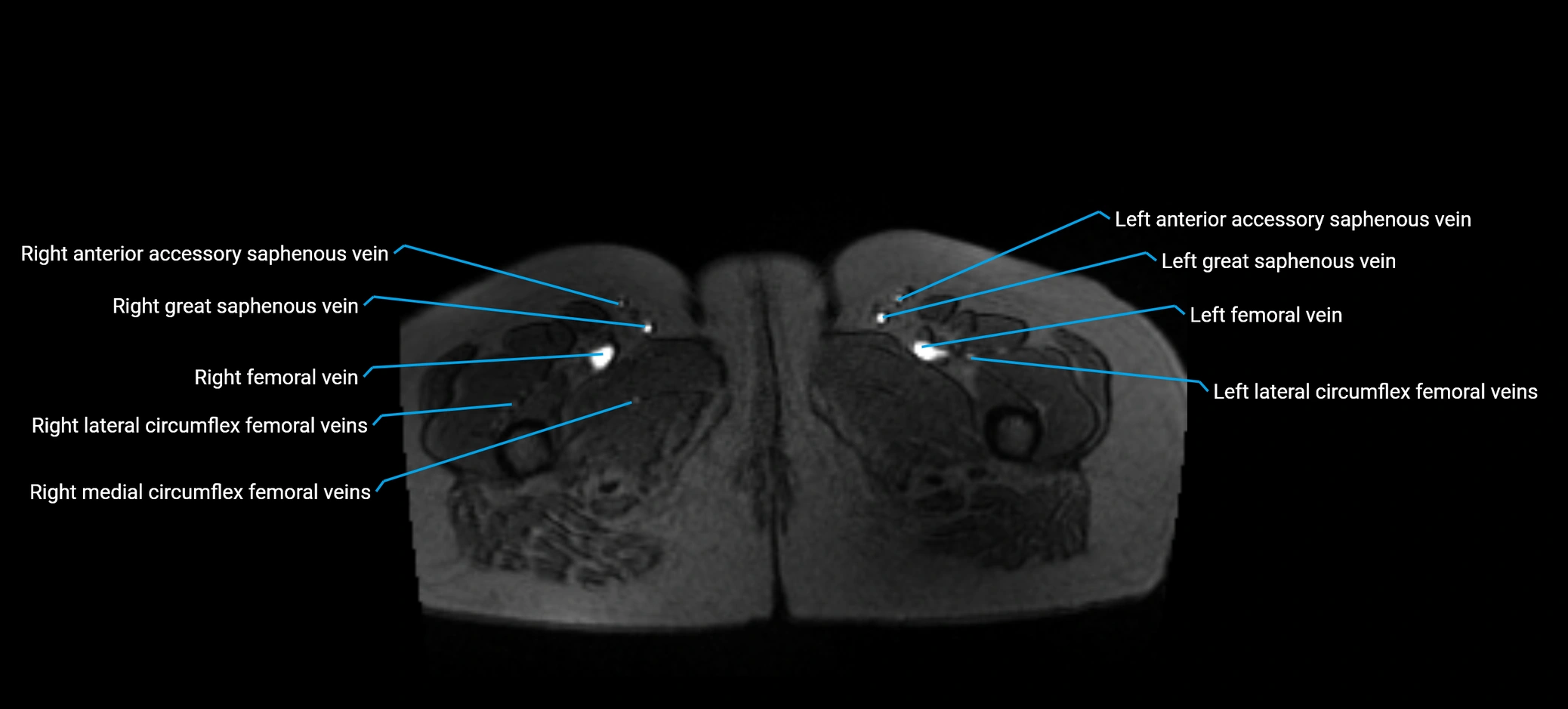 MRV abdomen pelvis & lower limb axial cross sectional anatomy labelled MRI image 209 (1).webp